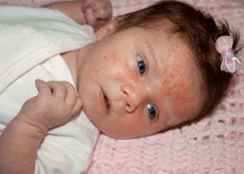 Baby Skin Allergy Home Remedies - Natural Solutions for Gentle Care