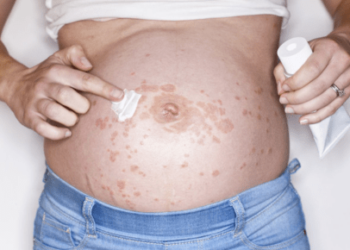 Skin Allergy During Pregnancy - Understanding and Managing Symptoms