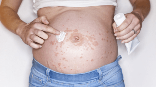 Skin Allergy During Pregnancy - Understanding and Managing Symptoms