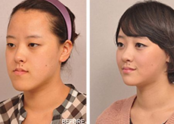 Exploring Korean Plastic Surgery - Before and After