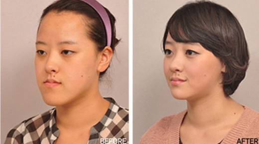 Exploring Korean Plastic Surgery - Before and After