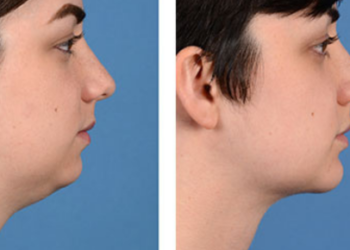 Exploring Male Plastic Surgery - Before and After