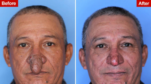 Guys Plastic Surgery Before and After - Exploring Transformations