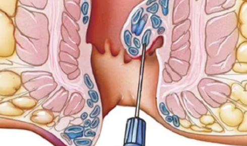 internal hemorrhoid treatment